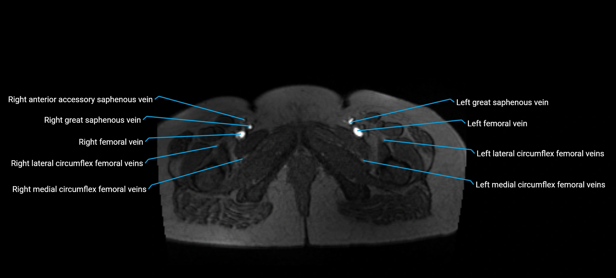 MRV abdomen pelvis & lower limb axial cross sectional anatomy labelled MRI image 199 (1).webp